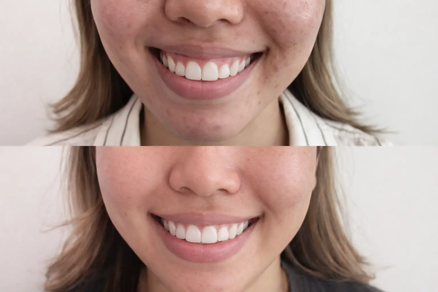 lip flip before and after